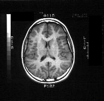 MRI of the brain - case 1