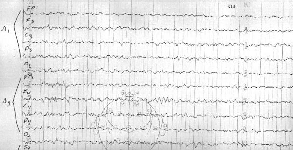 Case 3 - EEG