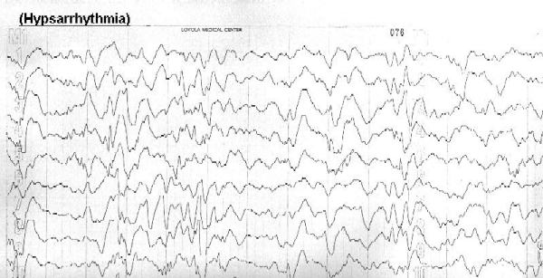 Case 5 - EEG