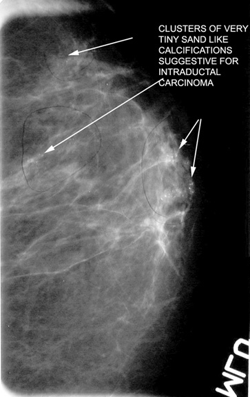 Smooth mass is infiltrating ductal carcinoma medullary type