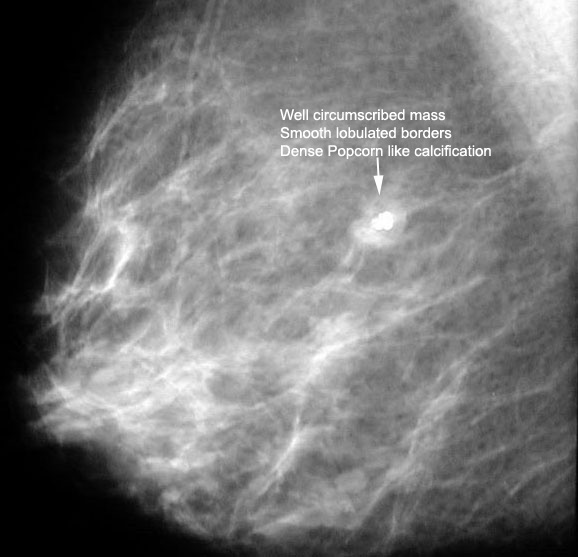 What is the classical appearance of cyst on mammography?