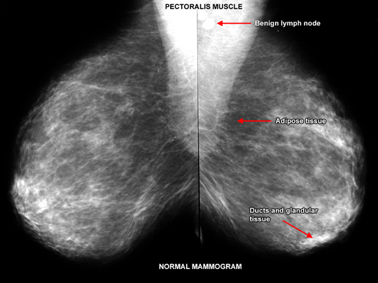 Atlas of breast cancer early detection