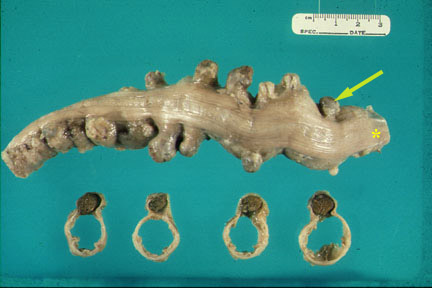 What Does Poop Look Like With Diverticulitis
