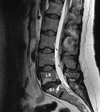 herniated disc x ray