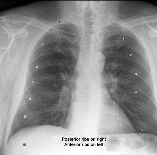 number the posterior and anterior ribs click the image for labeling