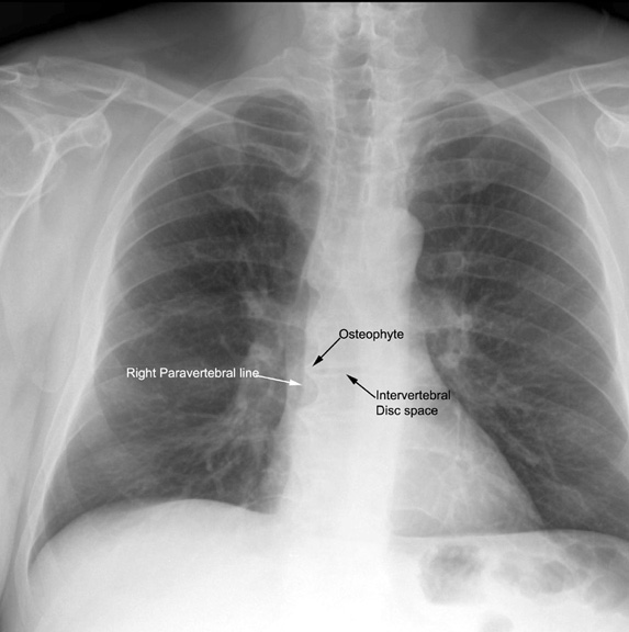 normal chest xray labeled