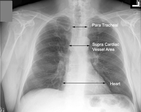 normal chest xray labeled