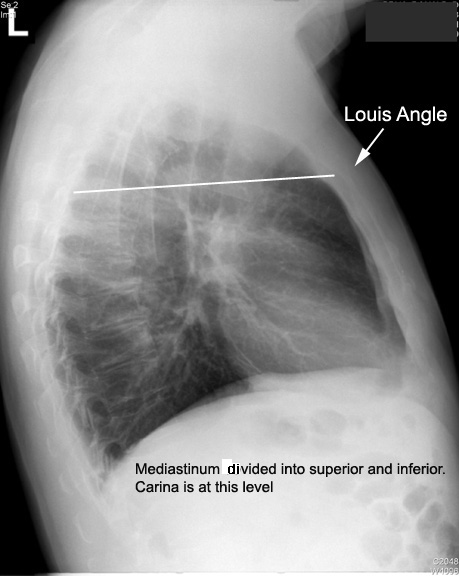 Sternal Angle of Louis 