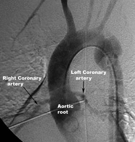 aortic root anatomy